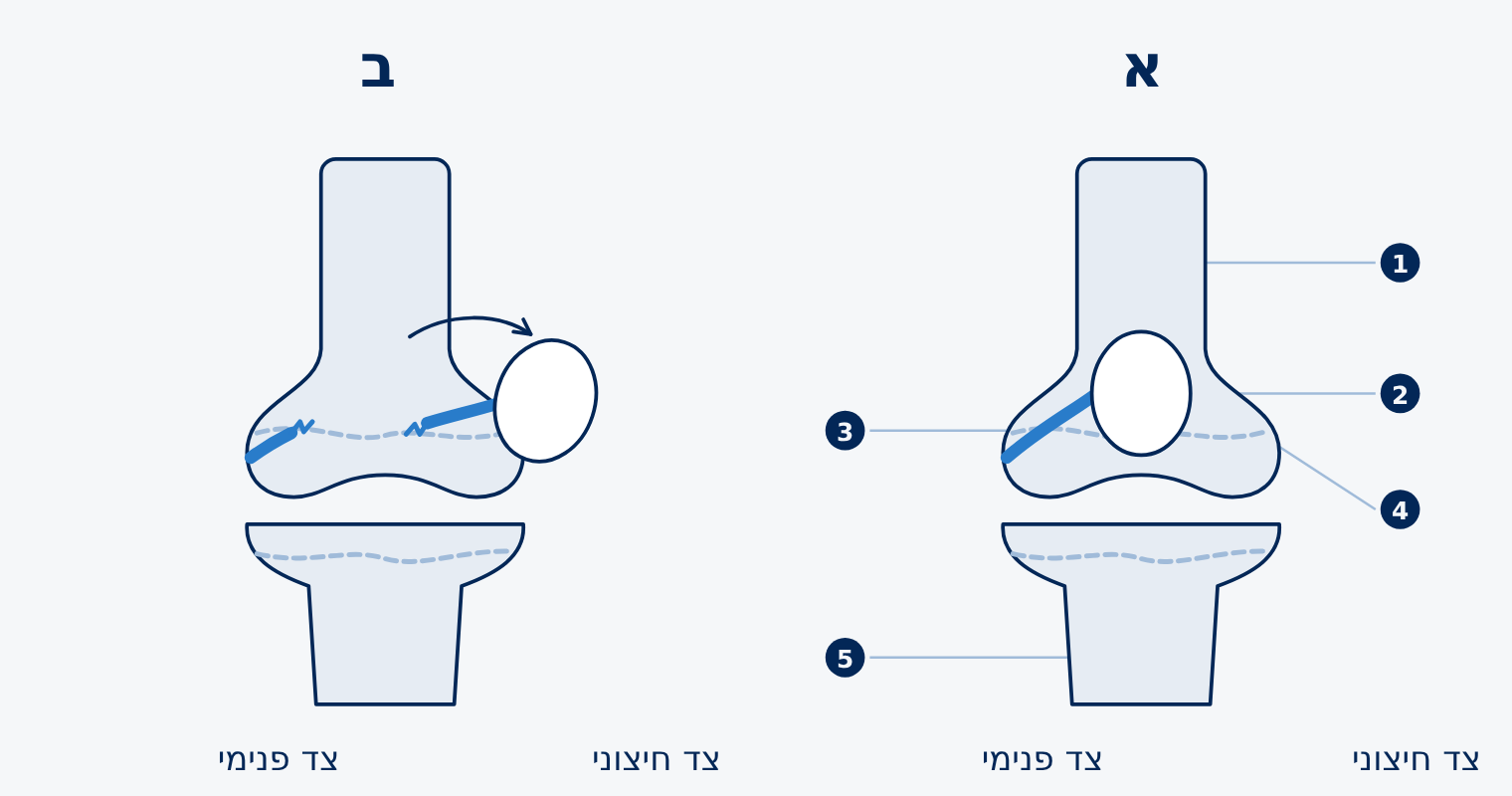 הברך מלפנים. א. הפיקה במקומה · ב. הפיקה פרוקה לצד החיצוני, והרצועה הפנימית קרועה.